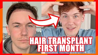 FUE Hair Transplant  First Month  1 Month Update on Progress  Swelling Sleeping Healing Growth [upl. by Eneloc584]