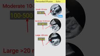 Amount of Pericardial Effusion by echo l हार्ट मै पानी की मात्रा इको से echo shorts [upl. by Nekal318]