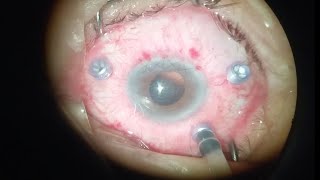 Pars plana vitrectomy with endolaser barrage 360° HD [upl. by Cannell186]