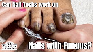 Pedicure Nail Fungus Transformation [upl. by Ermengarde]