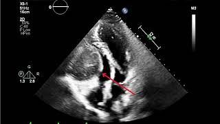 Echocardiogram of Rare Right Ventricular Myxoma [upl. by Wilburt]