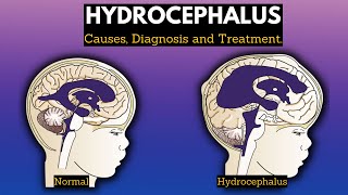 Hydrocephalus Causes Signs and Symptoms Diagnosis and Treatment [upl. by Odlauso637]