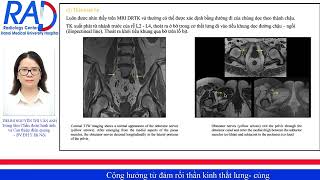 CỘNG HƯỞNG TỪ ĐÁM RỐI THẦN KINH THẮT LƯNG  CÙNG [upl. by Nauqet335]