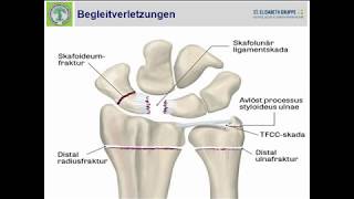 0716  Begleitverletzungen der distalen Radiusfraktur [upl. by Aneerak892]