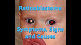 Retinoblastoma  Symptoms Signs and Causes [upl. by Sophia]