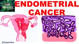 ENDOMETRIAL CARCINOMA Risk factors Etiopathogenesis Morphology amp Clinical features [upl. by Vharat]