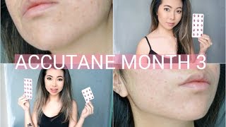 3 Month Accutane Update \ Side Effects [upl. by Esdnyl222]