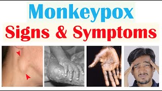 Monkeypox Signs amp Symptoms First Symptom amp Stages of Rash [upl. by Eileek]