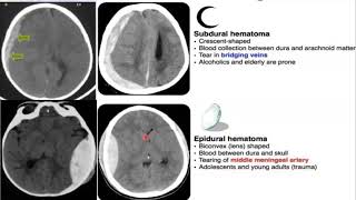 Emergency Neuroradiology Session 1 Spontaneous ICH amp Brain Aneurysms [upl. by Keemahs]