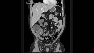 CT Abdomen  Coronal section  Radiological Anatomy  Dr Nithin K Raju [upl. by Lubow]