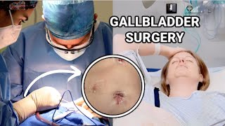 SURGERY FOOTAGE GALLBLADDER REMOVAL SURGERY VLOG [upl. by Zora]