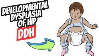 Developmental Dysplasia of the Hip DDH  Diagnosis and Treatment [upl. by Lyrradal]