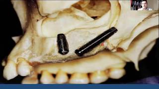 Webinar The Use of Pterygoid Implants for the Treatment of the Atrophic Maxilla [upl. by Rebah]