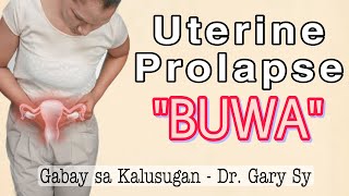 Uterine Prolapse BUWA  Dr Gary Sy [upl. by Cinderella]