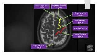 MRI Brain Sectional Anatomy Section 2 [upl. by Gayner751]