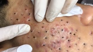 Big Cystic Acne Blackheads Extraction Blackheads amp Milia Whiteheads Removal Pimple Popping  612 [upl. by Elletse]