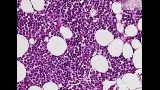 Histopathology BoneMultiple myeloma [upl. by Eedeed]