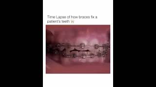 Time Lapse of how braces fix a patients teeth shorts [upl. by Audra]