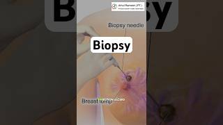 Biopsy medical athulrameshpt youtubeshorts shorts youtube medical health cancer [upl. by Bloem395]