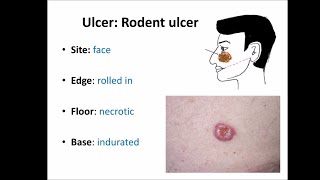 Basal cell carcinoma BCC [upl. by Swithbert]