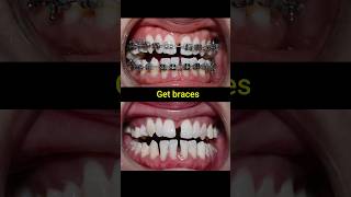 Braces evolution braces orthodontist dentist dental [upl. by Dalohcin]