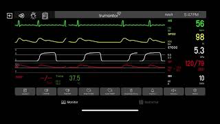 Atrial Flutter [upl. by Binny]