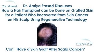 How a Hair Transplant can be done on Grafted andor Scarred Skin [upl. by Sixele203]