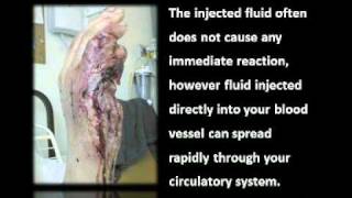 Fluid Injection Injury [upl. by Haorbed71]