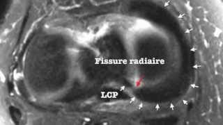 Fissure radiaire de la racine postérieure du ménisque médial  IRM 3D [upl. by Heilner]