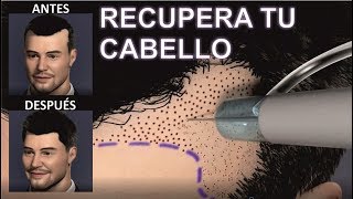 IMPLANTE o INJERTO de CABELLO 💕🙆 para MUJERES Y HOMBRES  Todas las RESPUESTAS  DR ALBERTO CALVO [upl. by Seth]