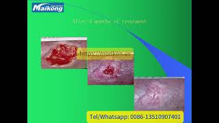 MAIKONG Diabetic Foot Capillaries Therapy SystemPDN [upl. by Terryn675]