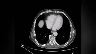 TDM ABDOMINO PELV Distension aérique colique avec stase stercorale colique diffusefécalome rectal [upl. by Erline]