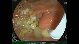 Choledocholithiasis amp Suppurative cholangitis [upl. by Femi598]