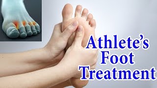 Athletes Foot Fungal Infection Home Treatment  5 Ways to Treat amp Avoid Athletes Foot at Home [upl. by Lenoj]