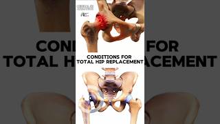 Conditions for Total Hip Replacement medical animation 3d short Biology with Aliya [upl. by Jordison]