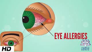 Eye Allergy Causes Signs and Symptoms Diagnosis and Treatment [upl. by Akemit]