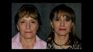 Mini Facelift and Fat Transfer Before amp After 68 Woman  minifacelift [upl. by Vern]