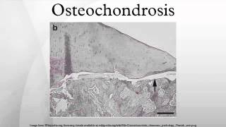 Osteochondrosis [upl. by Rubetta]