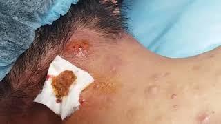 Extract Acne in Nape  HHV Clinic [upl. by Haelam730]