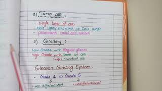 Prostate Carcinoma Pathology  Morphology and Gleason Grading [upl. by Spenser]