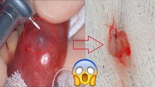 Home Remedies To Get Rid Of Mucocele Mucous Cyst For Good [upl. by Gerry4]