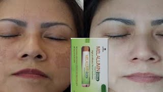 MELALUMIN ULTRA DEPIGMENTING CREAM USES IN HINDI  MELALUMIN ULTRA DEPIGMENTING CREAM REVIEW [upl. by Hasty798]