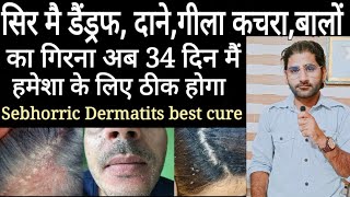 Sebhorric Dermatits best herbal treatment only in 34 dayssebhorric Dermatits ka permanent elaj [upl. by Barabbas]