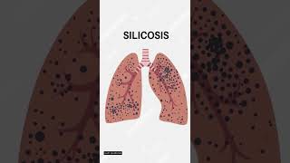 Hazards of Silica Exposure occupationalhazard silicaexposure healthsafety [upl. by Figueroa]