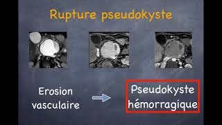 Pancréatite aiguë  4 Complications tardives [upl. by Eltotsira988]