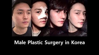 Male Eyelid Surgery and Rhinoplasty in Korea [upl. by Hands]