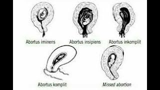 ABORTUS  MACAM MACAM ABORTUS  ASUHAN KEBIDANAN [upl. by Llerrom]