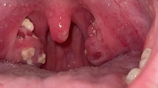 how to get rid of bad breath from tonsil stones [upl. by Lightman]