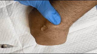 Drainage of a Ganglion Cyst [upl. by Gavrah315]