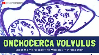 Onchocerca volvulus under the microscope with Massons trichrome stain [upl. by Dickenson191]